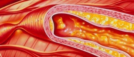 血管堵塞|血栓“清道夫”找到了！芹菜排第三，排在第一很多人都并不知道