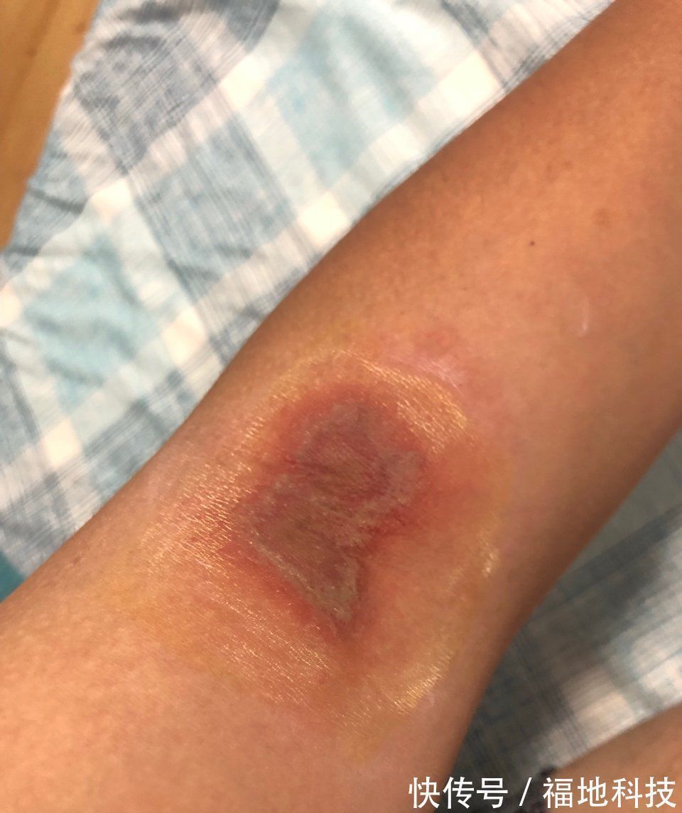 男孩|6岁男孩只因惹了这个小家伙脸部皮肤溃烂。麻烦就在“举手之间”