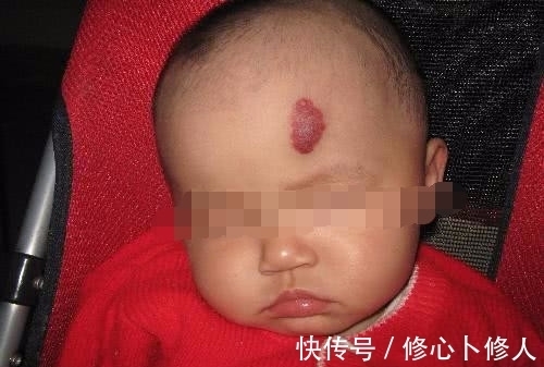 胎记|宝宝眉心有胎记,宝妈却不以为然,12个月宝宝送医抢救无效