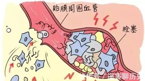 羊水|分娩后或分娩过程中，为什么医生担心产妇出现咳嗽？