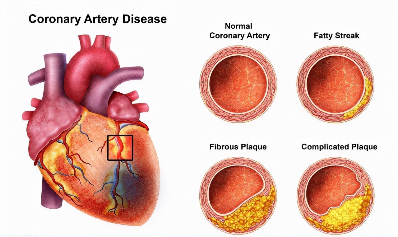冠心病心绞痛|2个中成药,改善冠心病心绞痛,多靶点抗动脉粥样硬化,缩小斑块