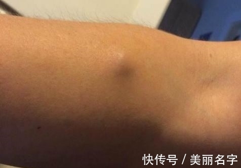 手臂|男子手臂有小肿块未在意,感觉疼痛后就医,取出的东西令人不冷静