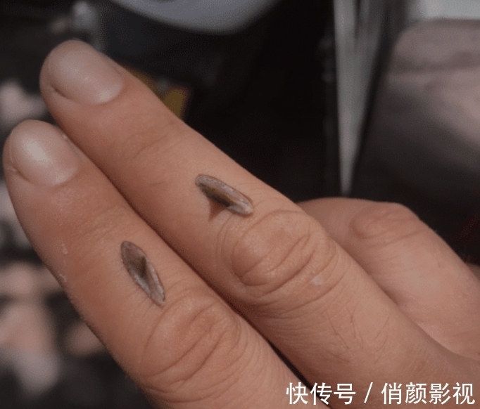 医院|“手上长了两根硬刺,去医院看什么科?”哈哈