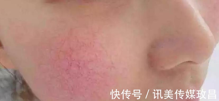 炎症|比“抗衰”更重要!它才是日常护肤的刚需,很多人都做错了