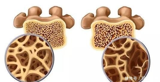  提升|70岁大爷骨密度从-3提升到0.4，经验是常服1物，骨不疏松