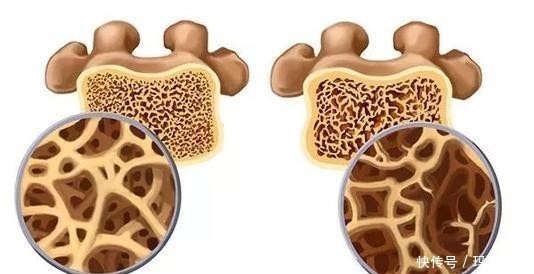 提升|70岁大爷骨密度从-3提升到0.4,经验是常服1物,骨不疏松