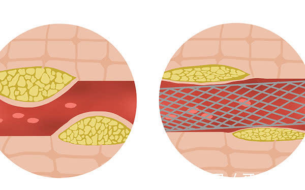 心脏支架|放了心脏支架血管会不会再堵？还能长寿吗？提醒：有3点要牢记