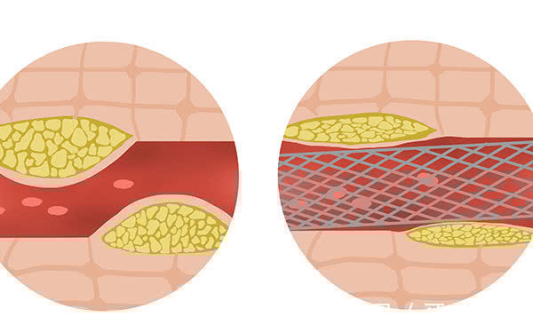 心脏支架|放了心脏支架血管会不会再堵?还能长寿吗?提醒:有3点要牢记
