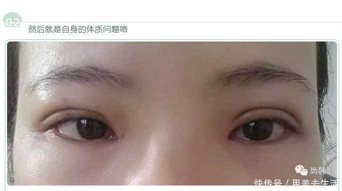 恢复|为啥割了双眼皮以后,你恢复的比别人慢
