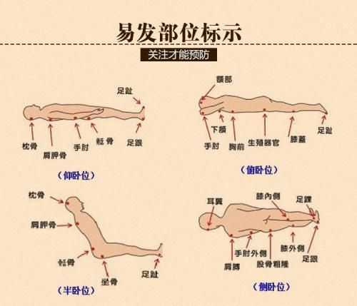  病人|经常卧床的病人如何预防压疮？出现压疮如何护理？