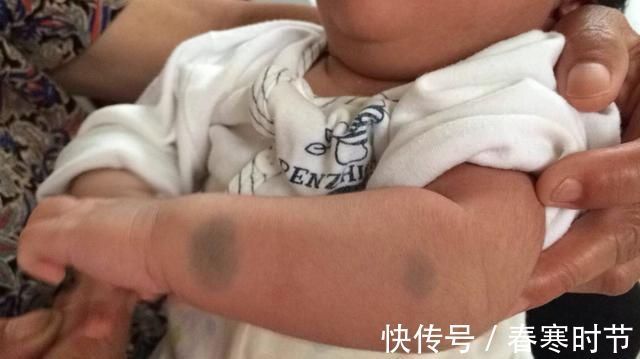 林静|宝宝出生屁股“淤青”，不要以为是天生，可能宝妈孕期做了这些事