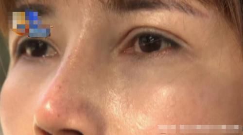 女子|女子接二连三做整容,做完“九度媚眼”之后,眼泪经常止不住往下流