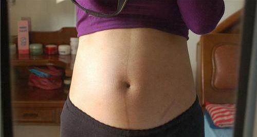 后遗症|剖腹产真的好?产科医生透露:起初是好,后遗症生二胎时才会暴露