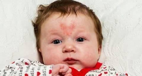 宝宝|孕期,这2件容易让胎宝宝长胎记的事最好别做,不然后悔都来不及