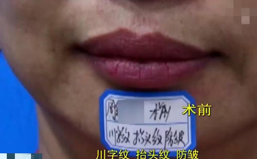 玻尿酸|玻尿酸注射一半，医生要求加3000再打一针？女子：把我当猪宰