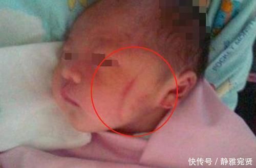 产妇|高龄产妇不听劝硬要生娃,顺产时医生被迫用产钳,女儿被毁容