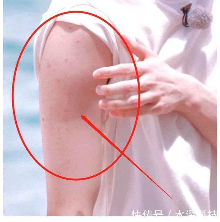 跑男|蔡徐坤参加跑男,大夏天穿羽绒服引关注,手臂上的红疹却让人心疼