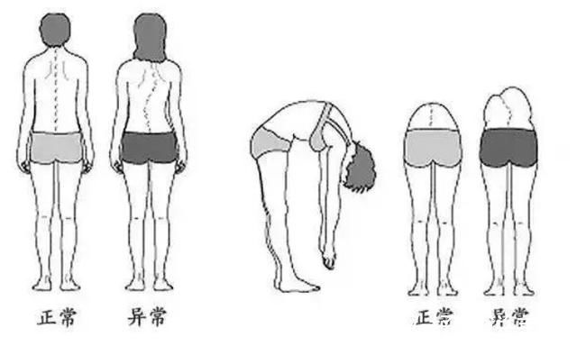 受压|8岁男孩脊椎侧弯,只因家人常做这个动作,这个错误,90%的父母都在犯