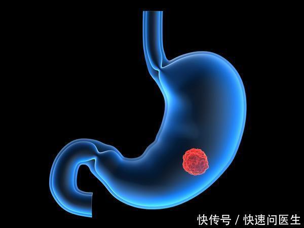 胃癌是拖出来的?医生常说:4种小病是祸根,及时治疗避免恶化