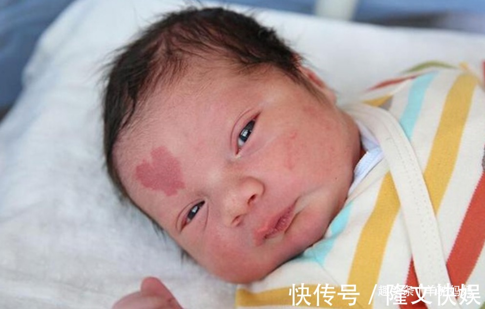 血管瘤|越来越多胎儿被“胎记”缠身,若不想孩子自卑,孕妈要管住自己