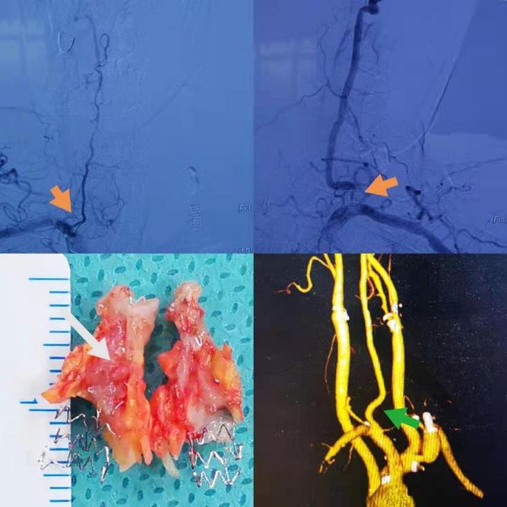 闭塞|新疆男子反复头晕四肢发麻，跨越千里到山东做手术