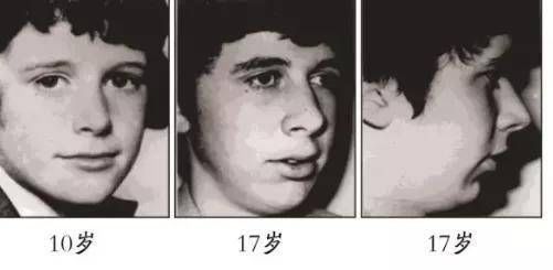 保守治疗|孩子腺样体肥大 到底要不要手术切除？