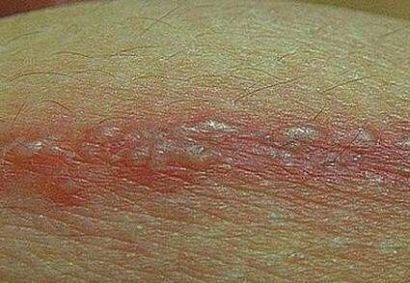 麻油|带状疱疹,别慌!一味药,加速止疼,四十年前的简陋办法