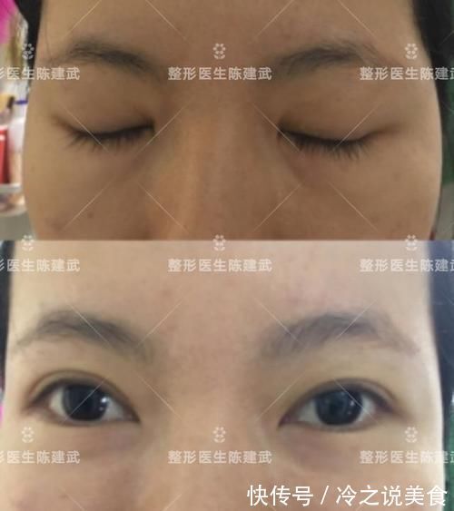 手术|32岁哺乳期女生,分享自己的求美经历:甩掉眼袋和泪沟不烦恼