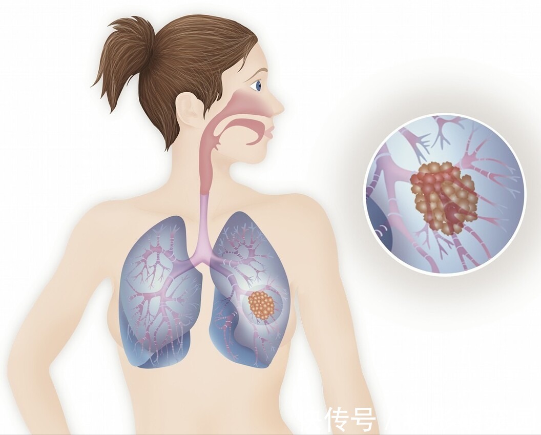 骨转移|得了肺癌什么时候会开始疼痛？因人而异，20%的人不会疼痛