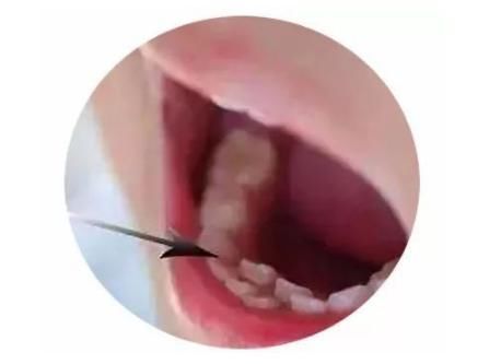 男孩|4岁男孩长出双排牙,只因父母太过“细养”孩子,医生太无知