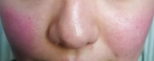 后果|全民护肤日：这些后果严重的皮肤病，却常常被忽视