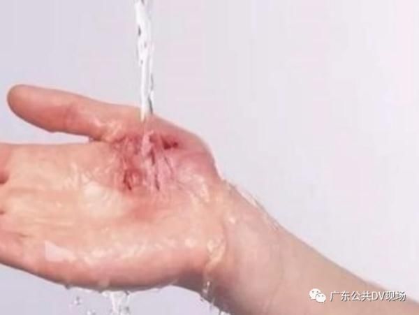 医生|女童掉进洗澡水被大面积烫伤,医生:牢记这5个字可救命