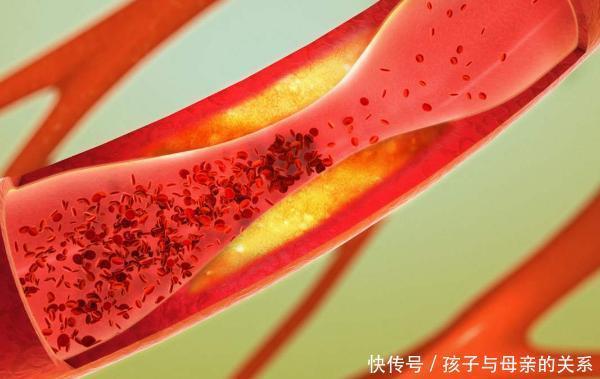 无关|高血脂的“祸根”被揪出,与肥肉无关,若爱吃,或许血栓不请自来