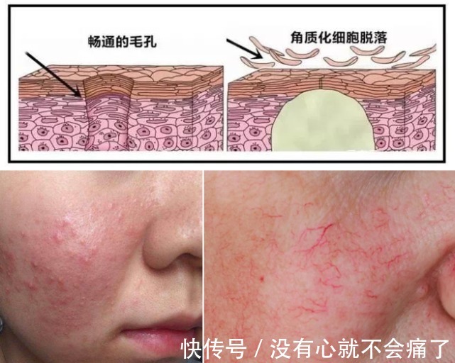 刺痛感|护肤品上脸后,皮肤刺痛真的是因为皮肤缺水吗?护肤必坑指南图解