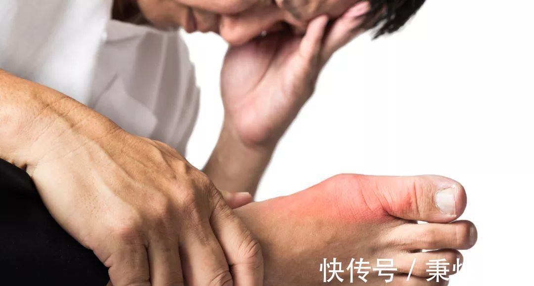 喝啤酒|三伏天已至,尽早停止这些“高嘌呤”举动,防止尿酸继续升高