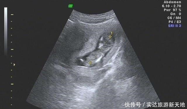 胎儿|孕期B超单直接反应胎儿状况,这5处孕妈要学会看懂,医生不会详说