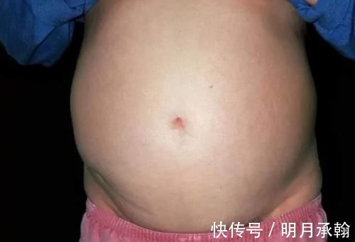 维生素d|10岁男孩,肚子鼓胀,查出肝癌,医生直言:奶奶的疼爱害了他