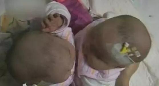 不良习惯|国内首例“连体双胞胎”,10年过去了现状如何?让人感慨万千