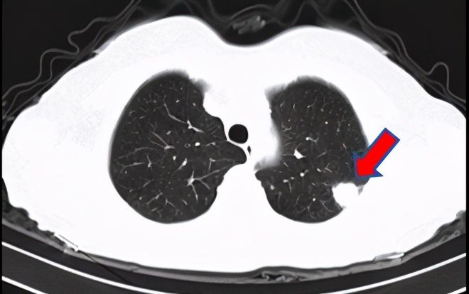结节|刀下“留肺”!容易误认为癌性“肺结节”的8种感染