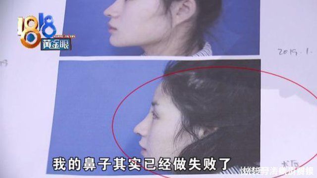 整形手术|女子整容花了6万多，整了个巫婆鼻，女子医生审美有问题