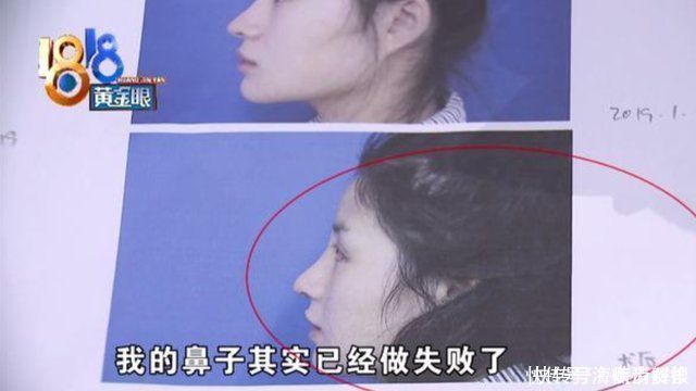 整形手术|女子整容花了6万多,整了个巫婆鼻,女子医生审美有问题