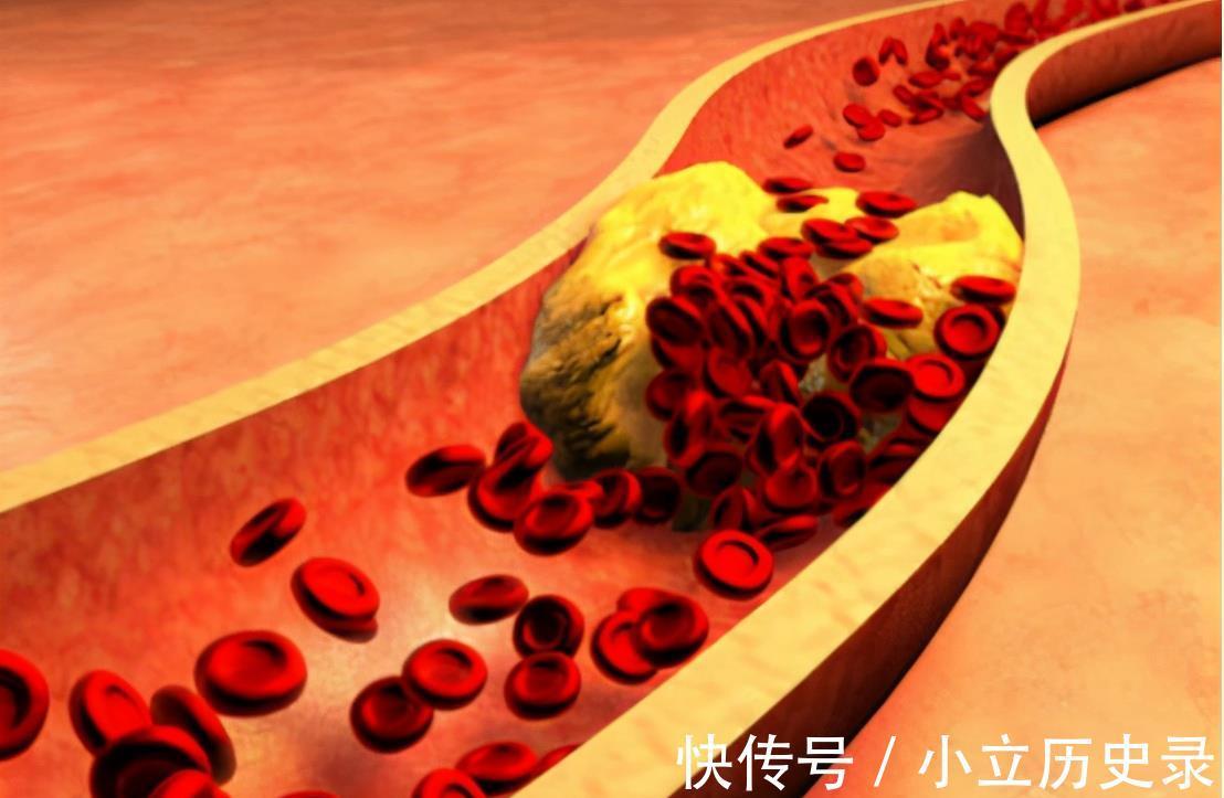 血管堵塞|研究脑梗40年,83岁院士,“3白”容易升血脂,劝你早日忌口