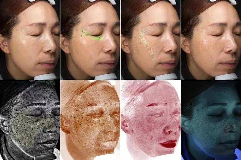 褪黑 祛斑失败后的怎么治疗