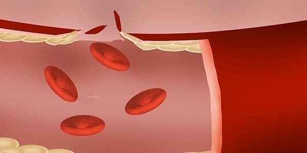 一杯酒|得了高血压的人，是不是不能继续喝酒了？若是喝了，会怎么样？