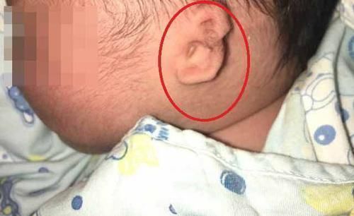 高龄产妇|孕期产检指标正常,孕妈却生下“畸形儿”,得知原因夫妻俩很崩溃