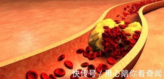 高血脂|血脂高的人有哪些表现呢？建议大家少吃这几种食物