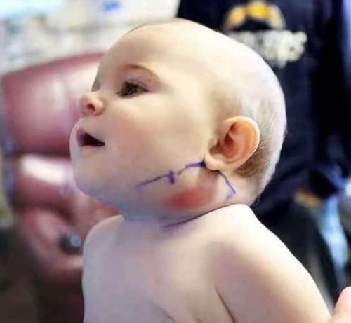 餐具|宝宝脖子长羽毛,家长当过敏治,医生说出原因家长吓出一身汗