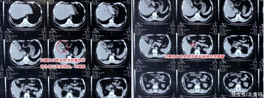 就医|反复腹胀以为是肠胃问题,一顿饱餐后突发腹痛就医才知真相