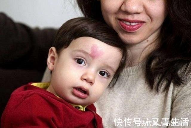 孕期|为什么有的宝宝会有“胎记”产科医生孕期要避免这3种行为