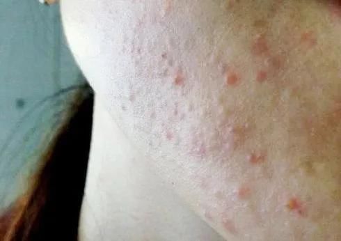 毛孔|闭口痘痘能做哪些皮肤管理？